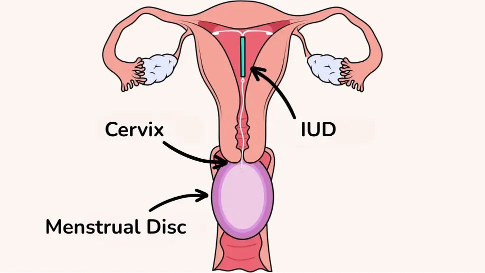 Are Menstrual Discs and IUDs Compatible?